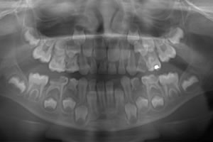 panoráma röntgen felvétel