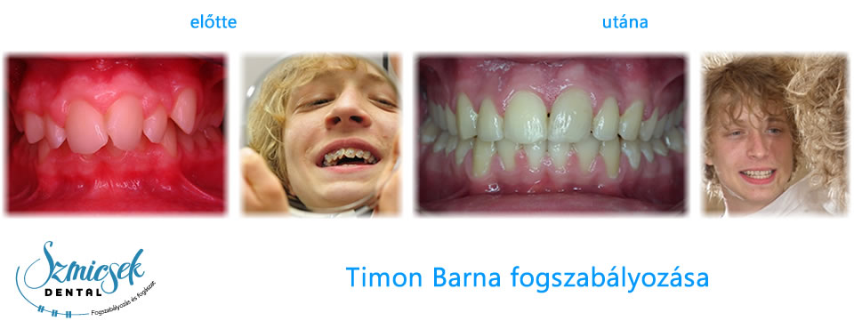 Timon Barna fogszabályozás előtte utána